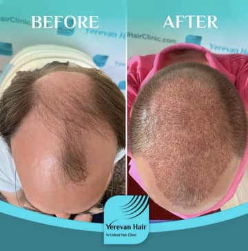 Slider image (3) United Hair Clinic